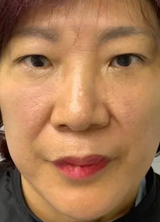 去眼袋手术