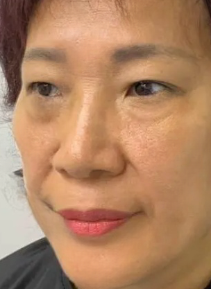 去眼袋手术