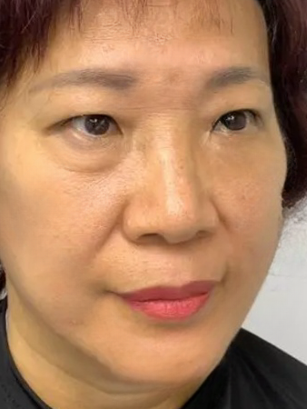 去眼袋手术
