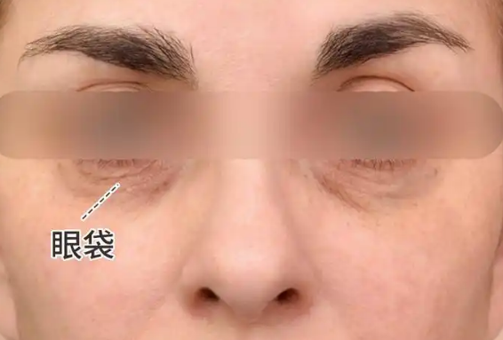 去眼袋手术