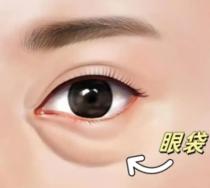 去眼袋手术