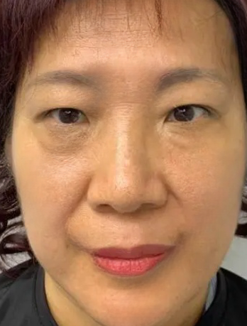 去眼袋手术