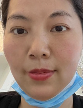 去眼袋手术