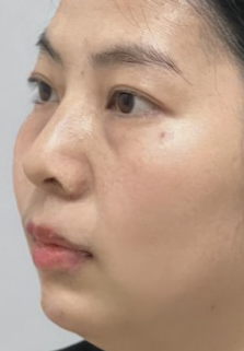 去眼袋手术