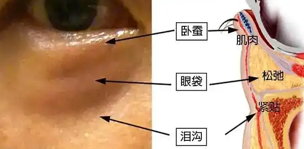 去眼袋手术