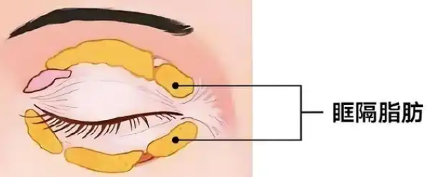 去眼袋手术
