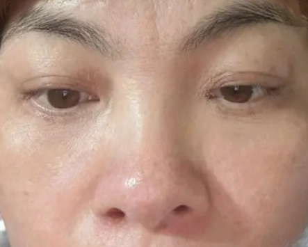 去眼袋手术