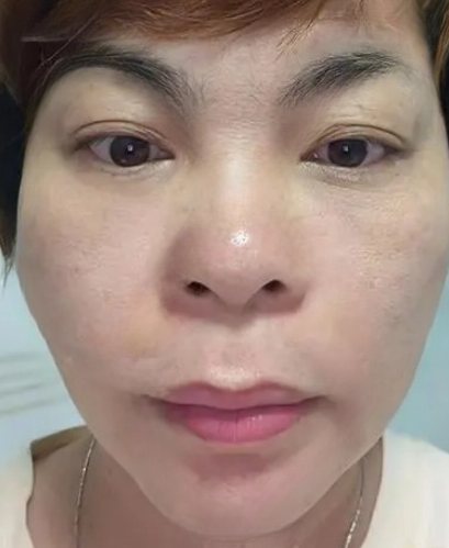 去眼袋手术