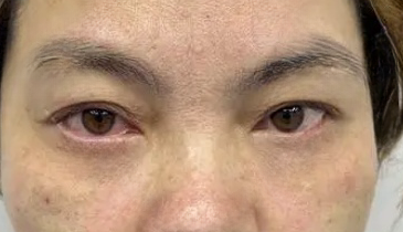 去眼袋手术