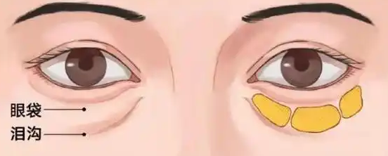 去眼袋手术