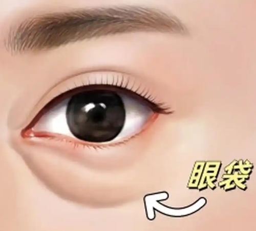 去眼袋手术