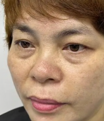 去眼袋手术