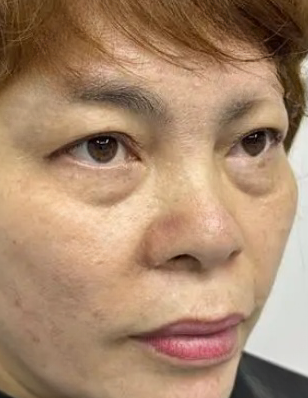 去眼袋手术