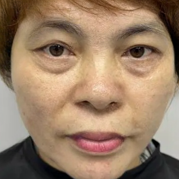 去眼袋手术