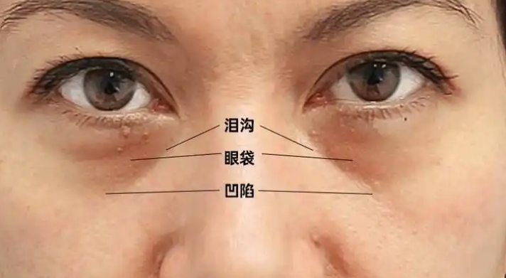 去眼袋手术