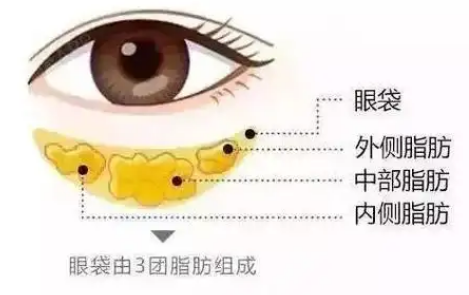 去眼袋手术