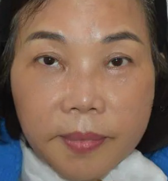 去眼袋手术