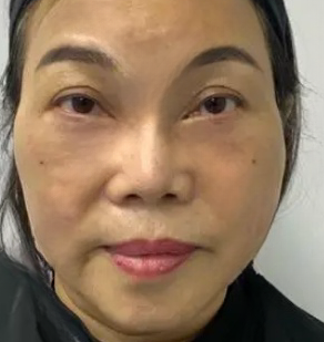 去眼袋手术