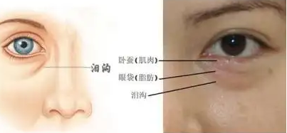 去眼袋手术