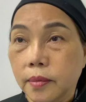 去眼袋手术