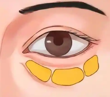 去眼袋手术