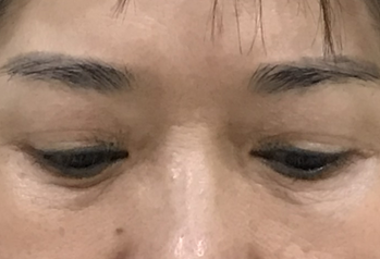 去眼袋手术
