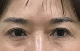 去眼袋手术
