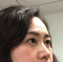 去眼袋手术