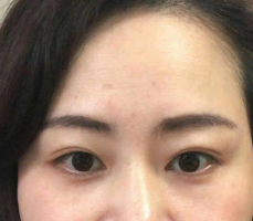 去眼袋手术