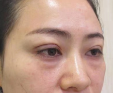 去眼袋手术