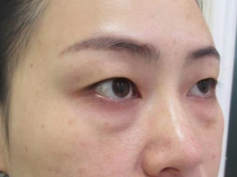 去眼袋手术