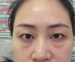 去眼袋手术