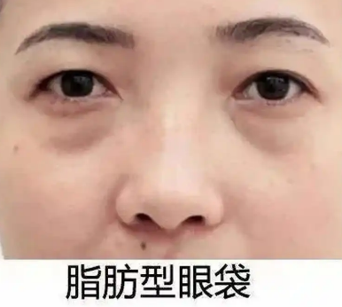 去眼袋手术