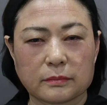 去眼袋手术