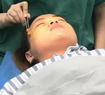 去眼袋手术