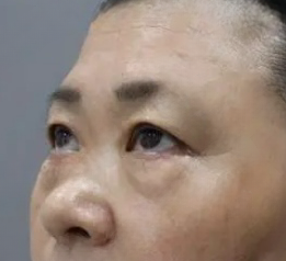 去眼袋手术