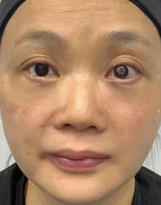 去眼袋手术