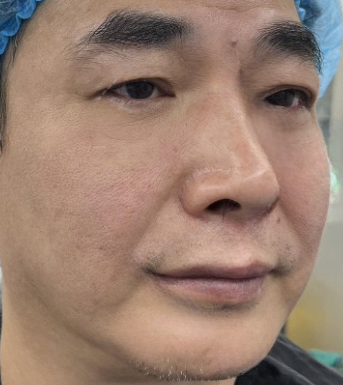 去眼袋手术