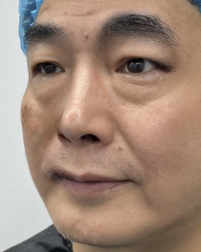 去眼袋手术
