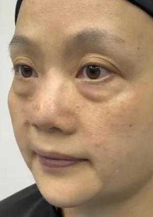 去眼袋手术