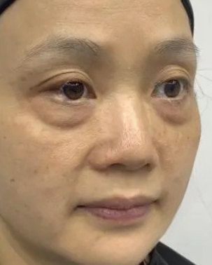 去眼袋手术