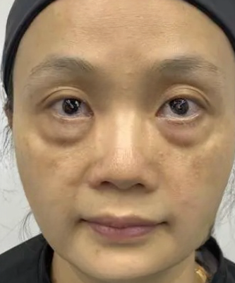 去眼袋手术