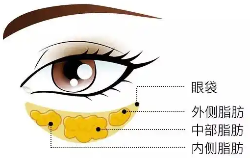 去眼袋手术