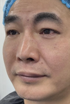 去眼袋手术