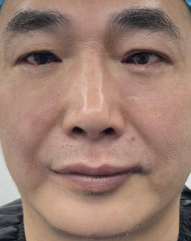 去眼袋手术