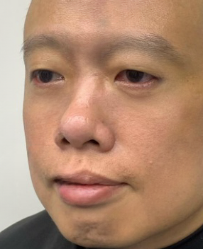 去眼袋手术