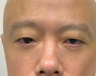 去眼袋手术