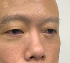 去眼袋手术