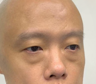 去眼袋手术