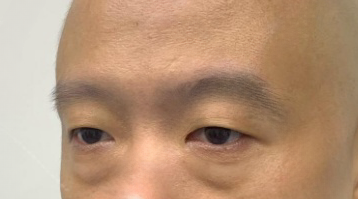 去眼袋手术